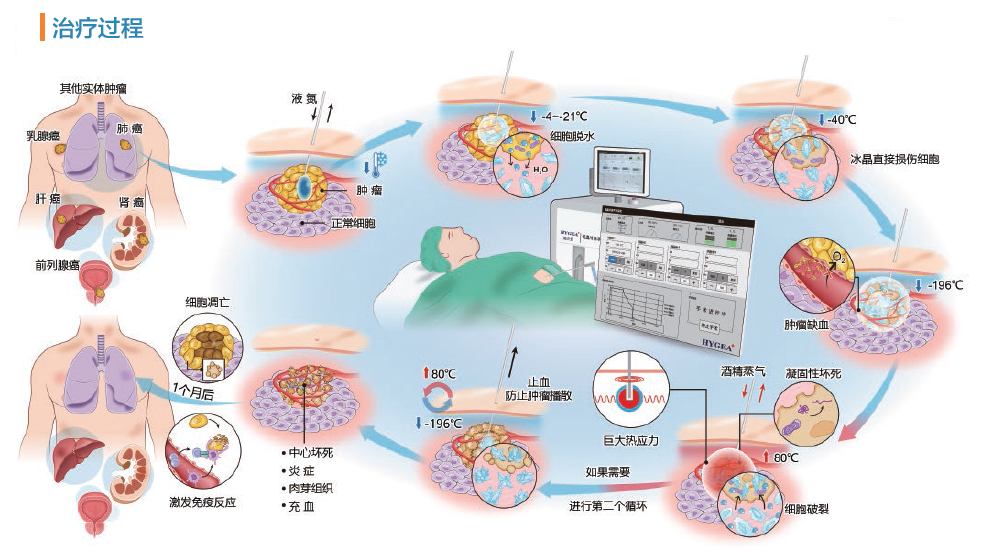 【Teknologji e re】Sistemi Epic Epic Co-Ablation – Trajtimi ndërhyrës i tumorit, duke përfituar më shumë pacientë