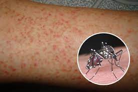 Dengės karštligės viruso padaugėja, sužinokite daugiau
