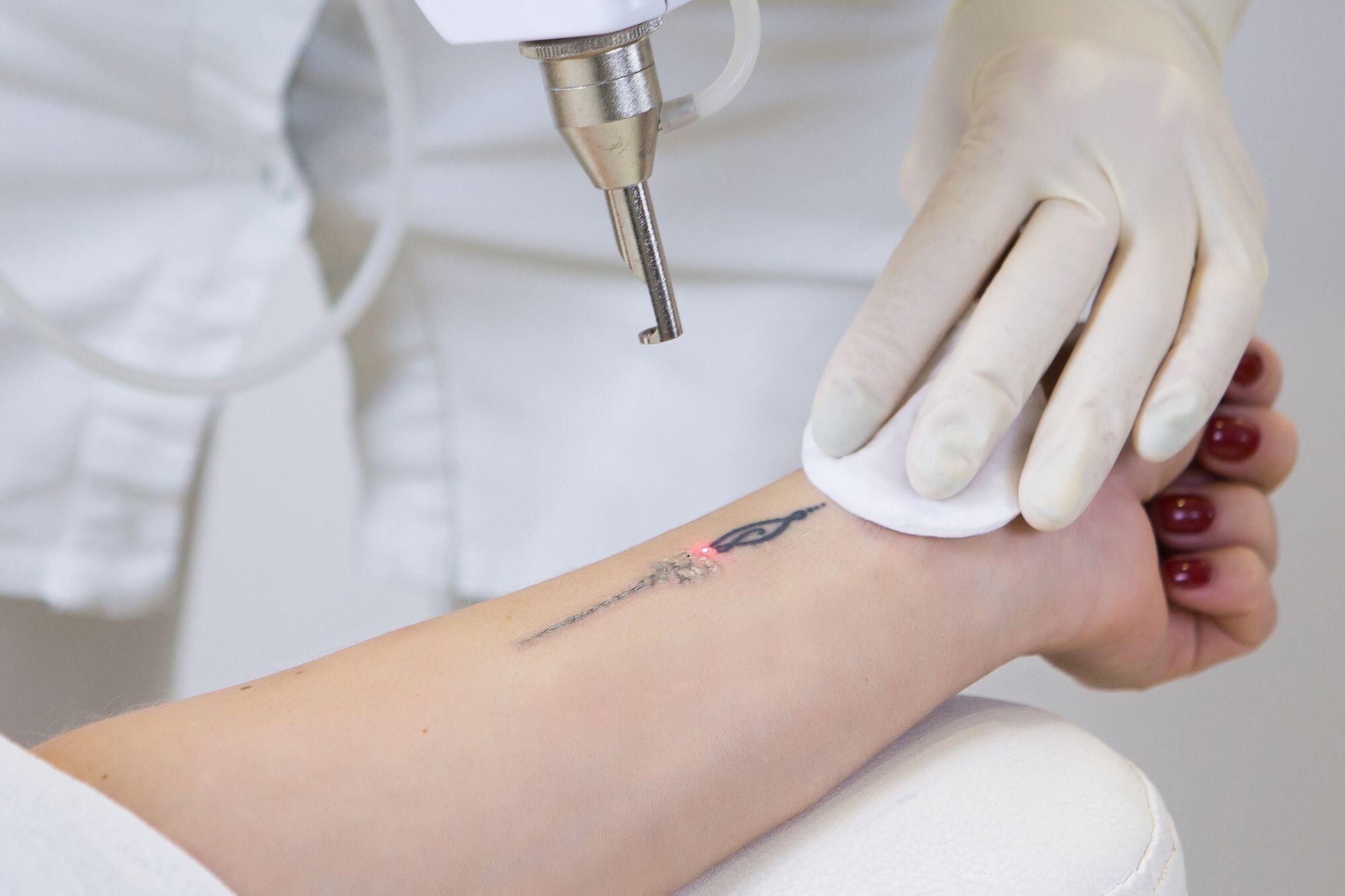 Які переваги лазерного видалення татуювань?