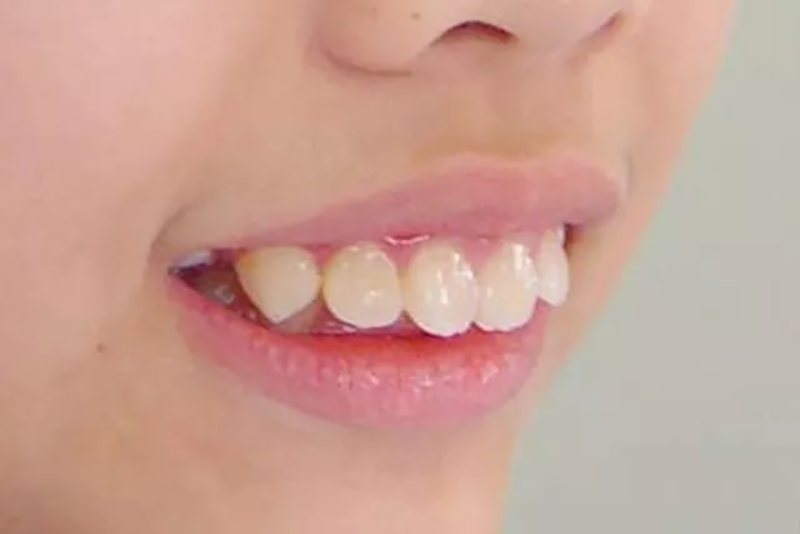 Ni ayika 7 ni akoko goolu orthodontics akọkọ.