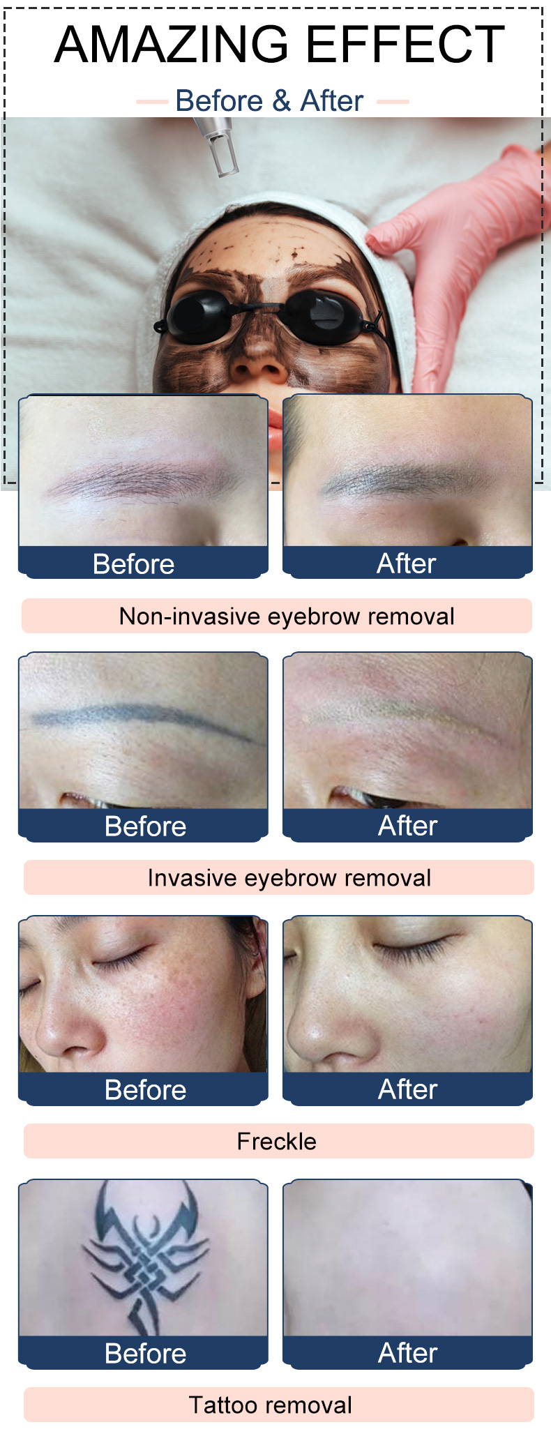 How do HIFU skin treatments work?