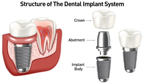 Зъбни импланти: Какво трябва да знаете