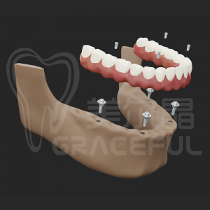Tooth Implant Abutment Titanium Framework