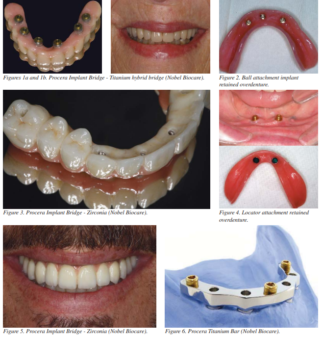 Pla de reparació d'implants dentals per a mandíbules edèntules
