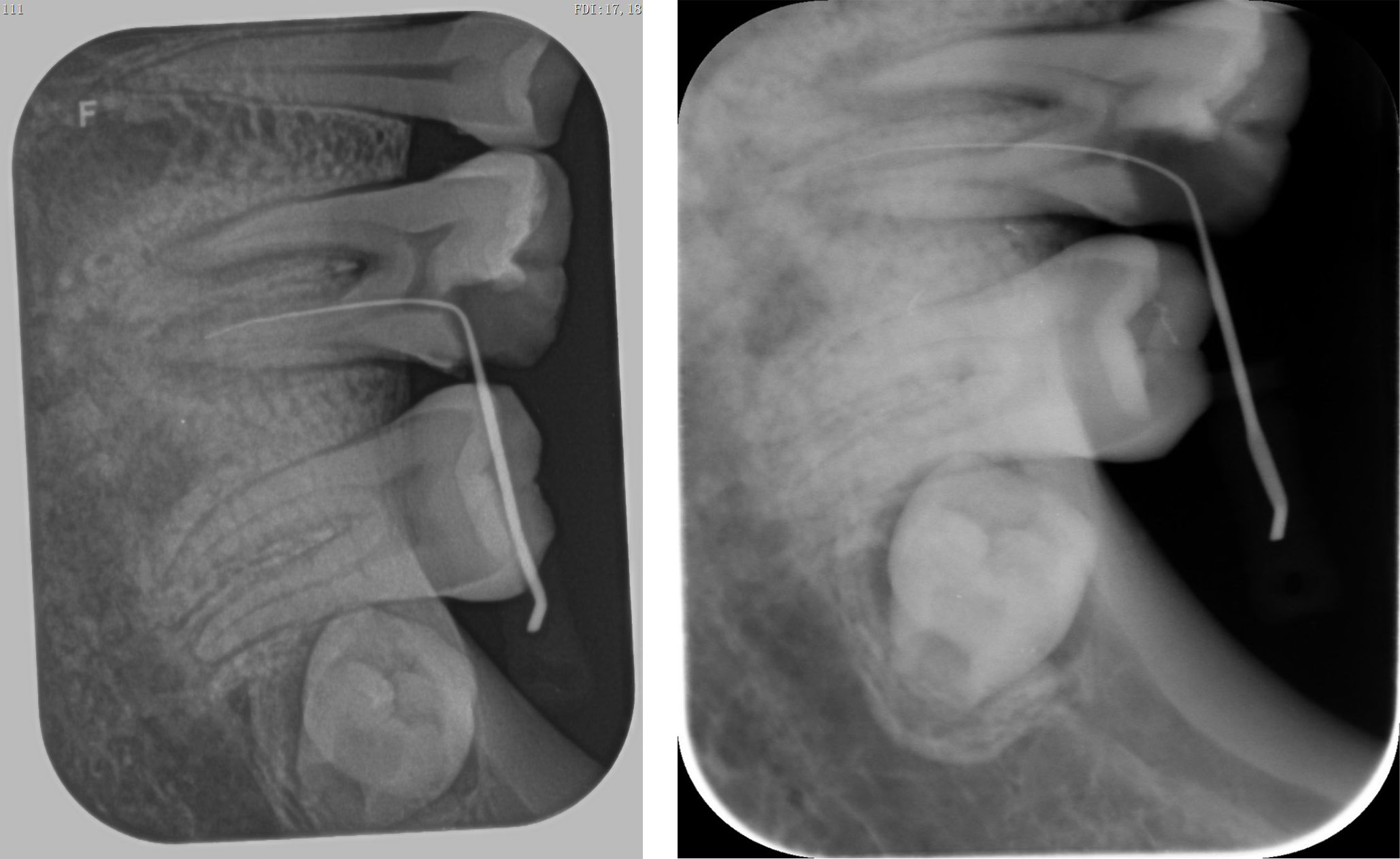 Lead shielding for dental x-rays: A thing of the past? | Dentistry IQ