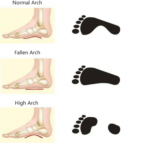 Por que cada vez máis persoas teñen problemas cos pés?
