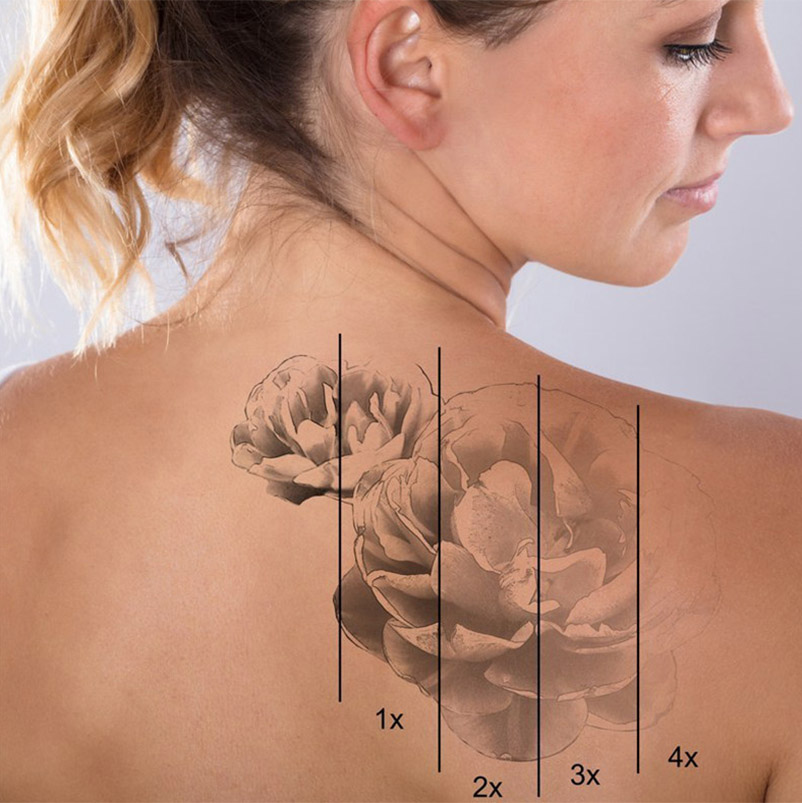 HOW MANY TREATMENTS ARE NEEDED FOR LASER TATTOO REMOVAL?