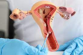 Chidzidzo: Uterine transplantation inzira inoshanda, yakachengeteka yekugadzirisa kushaya mbereko