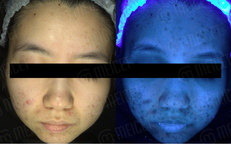 Waarom kan een huidanalysator huidproblemen detecteren?