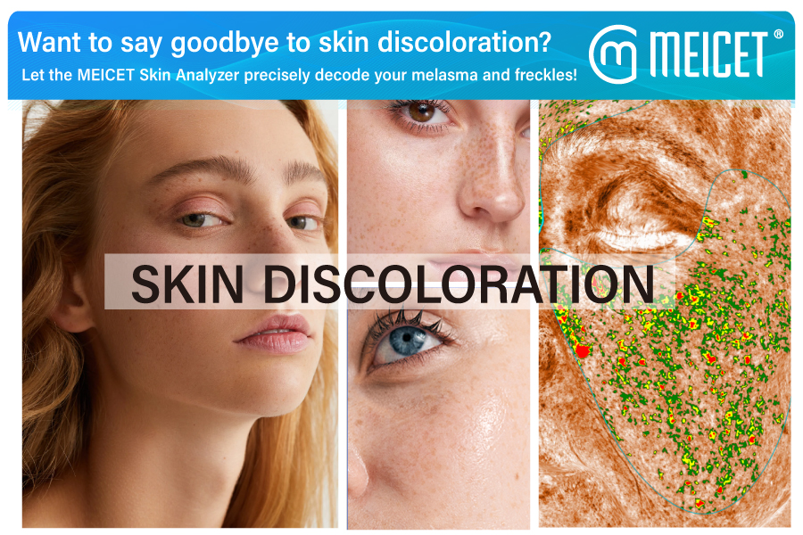 Want to say goodbye to skin discoloration? Let the MEICET Skin Analyzer precisely decode your melasma and freckles!