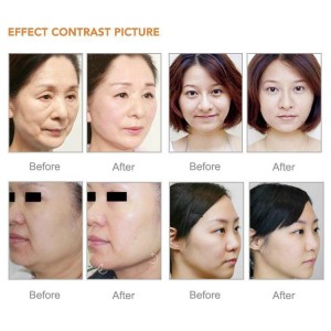 OEM fabrik til Kina Ultralyd Hifu Machine Face Lift Rynke Fjernelse Hifu Skin Stramning Machine