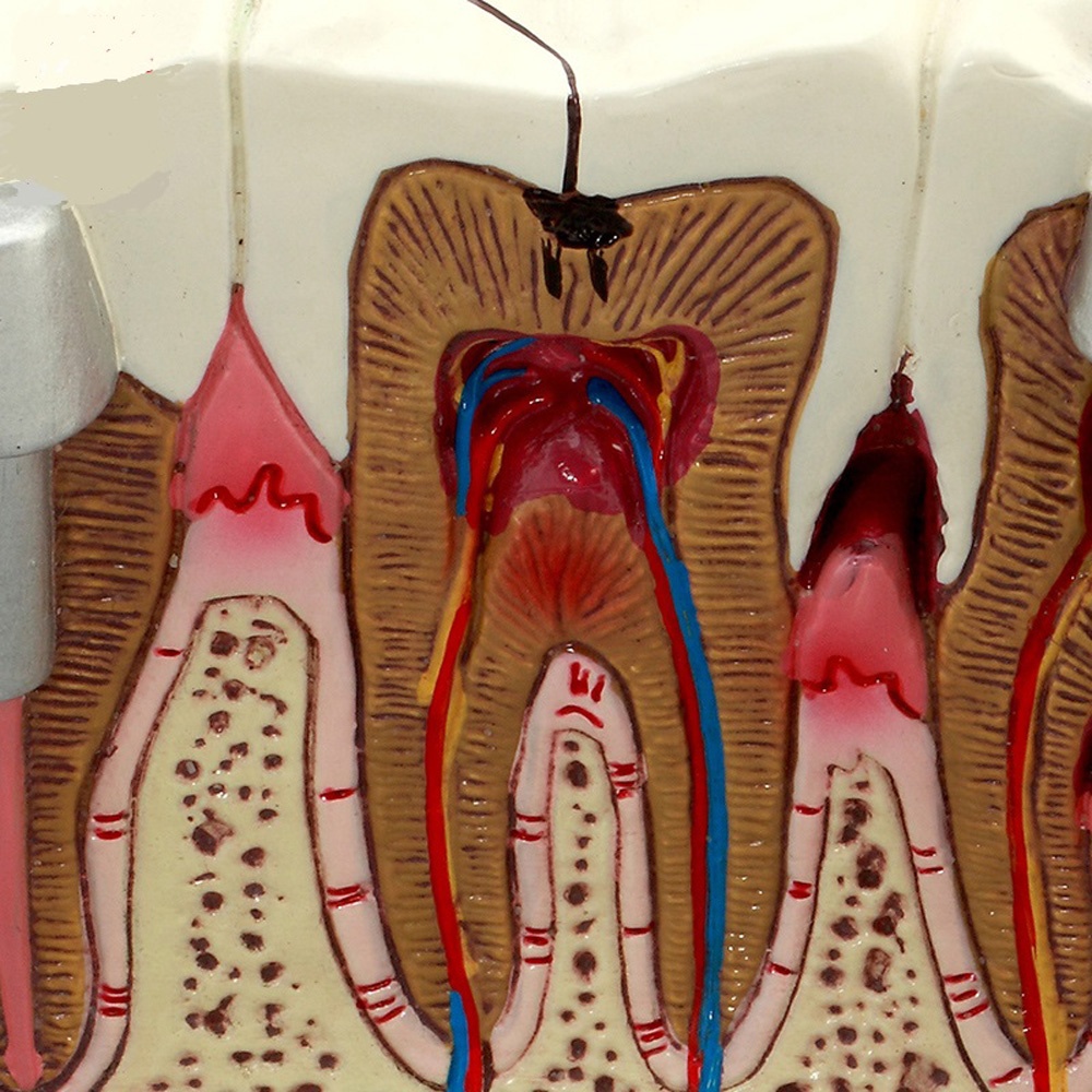 dental teaching use pathological teeth dental implant model removable teeth anatomical demonstration typodont