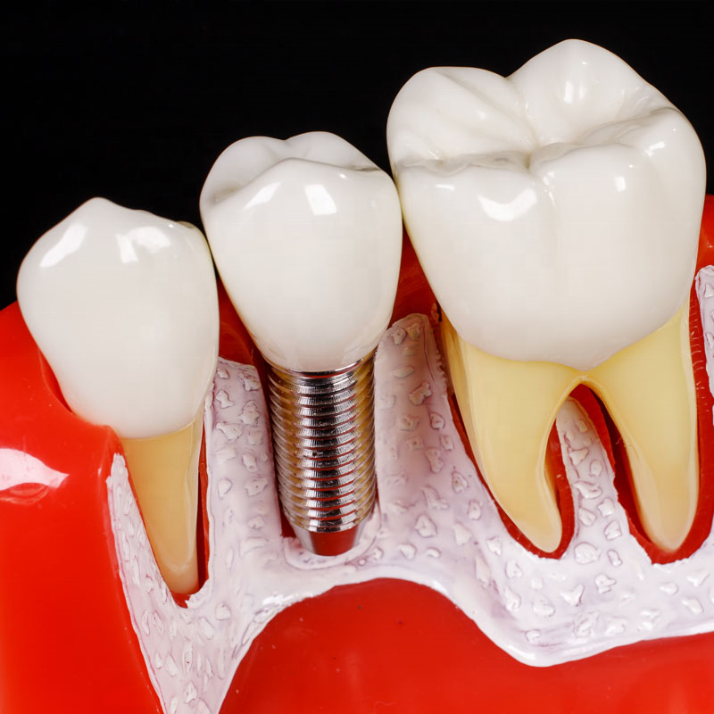 single implant demonstration model of dental implant analysis teaching and study orthodontic dental resin model