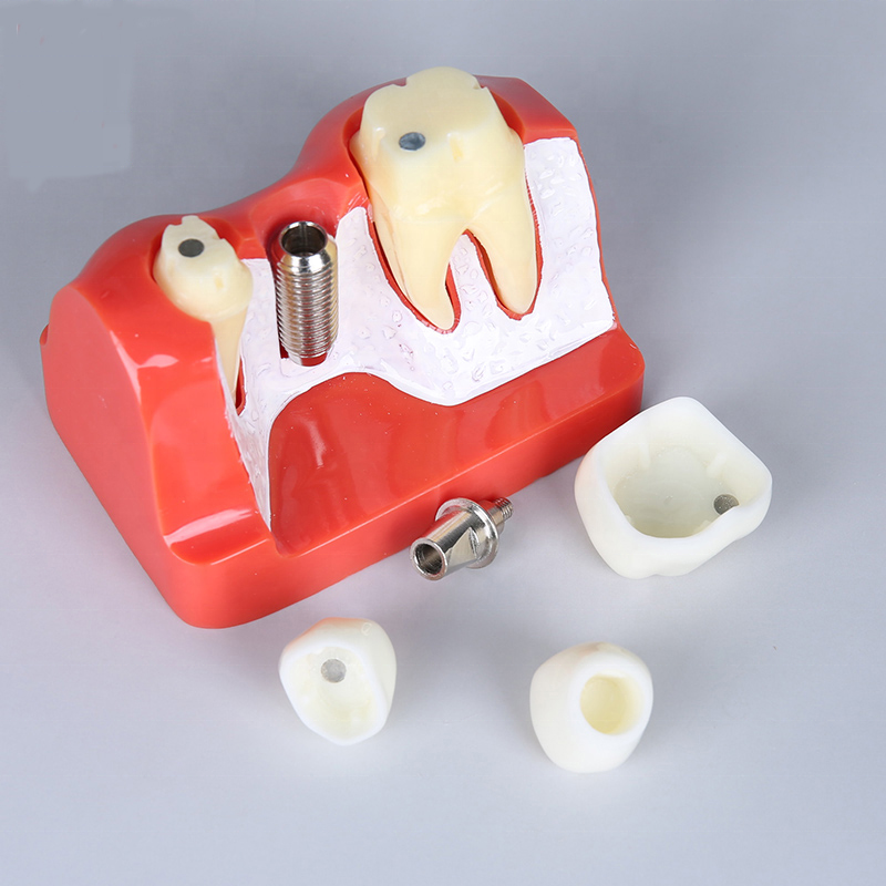 high quality medical dental implant science soft gum teeth model dental implant analysis tooth model dental instrument product