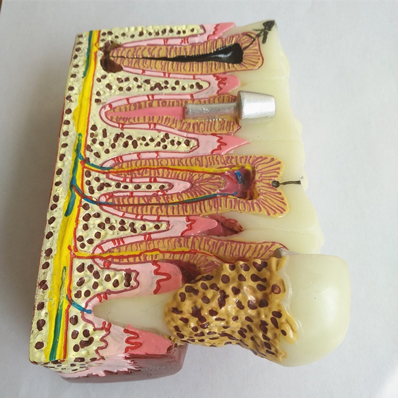 dental pathology demonstration model caries apicitis calculus gingivar recession root canal treatment model