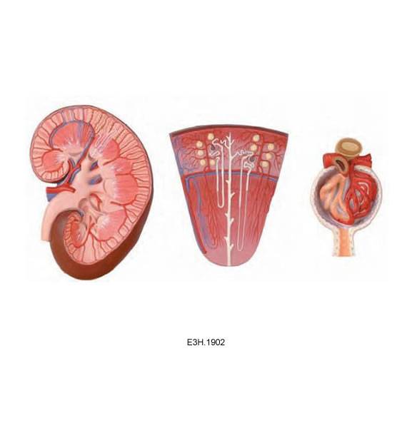 Enlarged Glumerulus,Nephron,Kidney