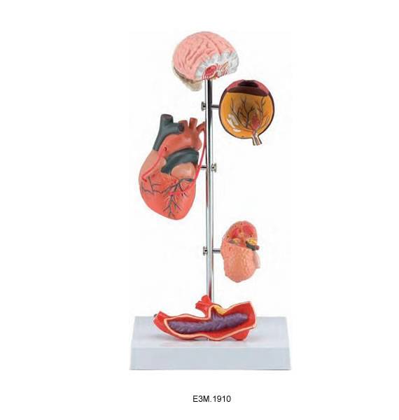 Hypertension Model II,5 parts