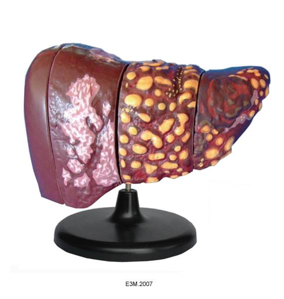 Disease Liver Model