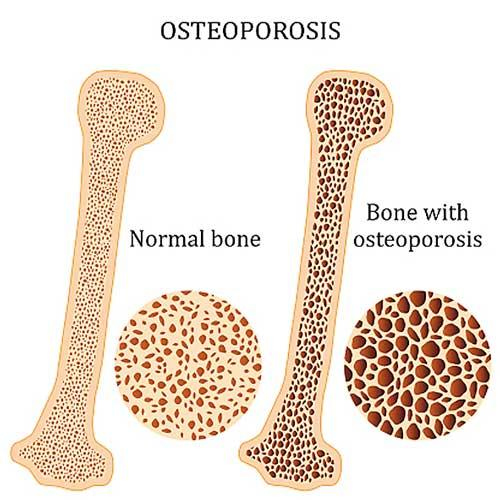 اهمیت تشخیص بالینی تراکم سنج معدنی استخوان