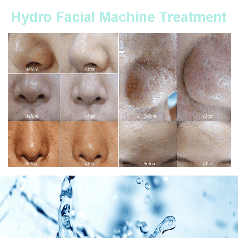 хидро-машина за чистење на кожа-01