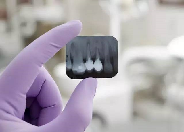Importance of Dental X-rays