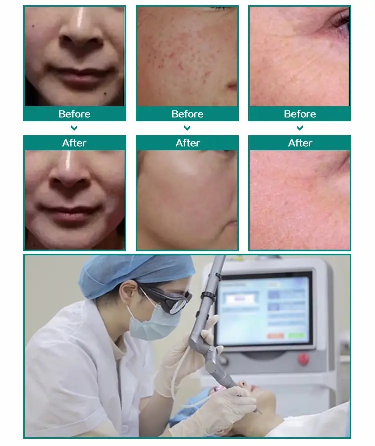 ʻO Fractional CO2 Laser Scar Removal Acne Treatment and Vaginal Tightening Machine