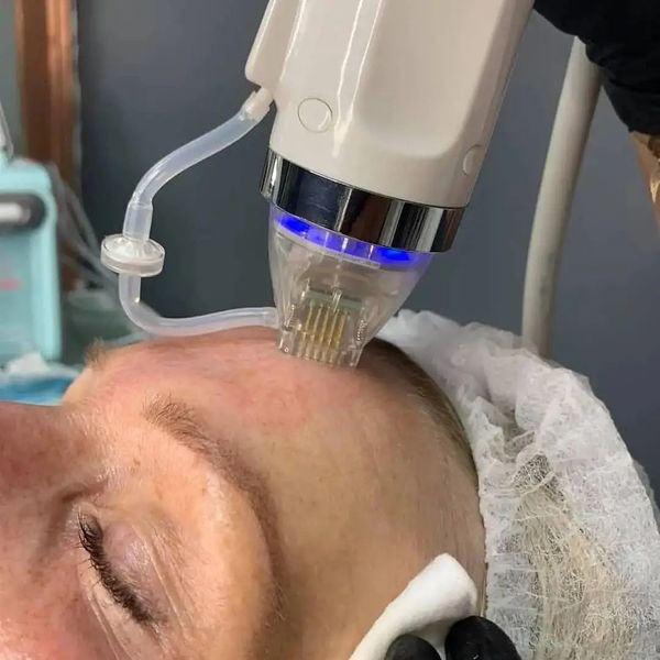 Things You Should Know About The Microneedling Treatment