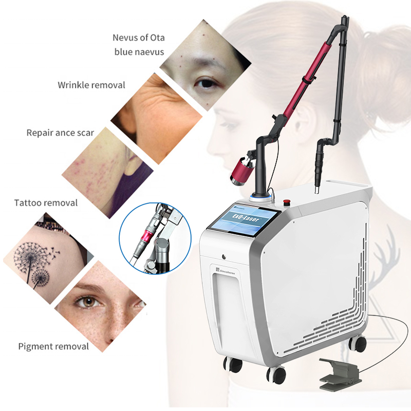 1064 nm 532nm Nd Yag Laser Picosecond laser   tattoo removal agents required nd yag q-switch laser machine width FDA Medcial CE Approved Pigmentation treatment Featured Image