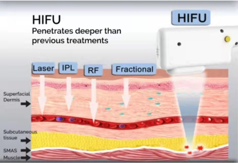 Radiofrekwensie met goue mikronaald + HIFU-pen + HIFU 4D + HIFU vaginale + Lipo sonix