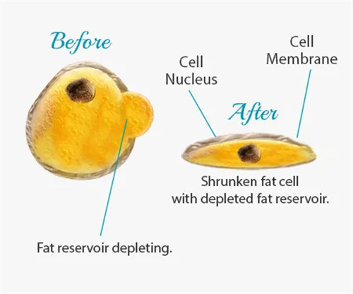 Non- Invasive Permanent Fat Reduction Ⅰ