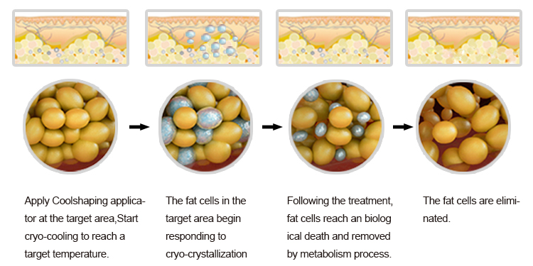 Cryolipolysis kill the fat cells
