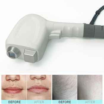 Laser multifonctionnel opt shr ipl traitement de la peau d'épilation au laser RF