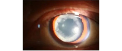 Како се катаракта развија и како је исправити?