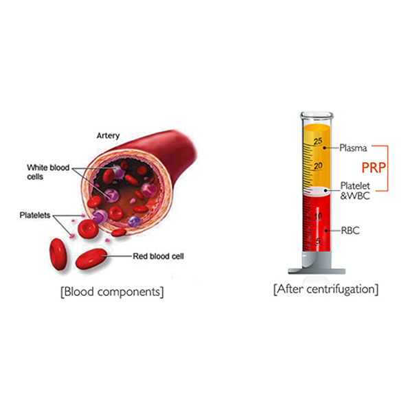 PRP autologni serum matične ćelije i njegove prednosti