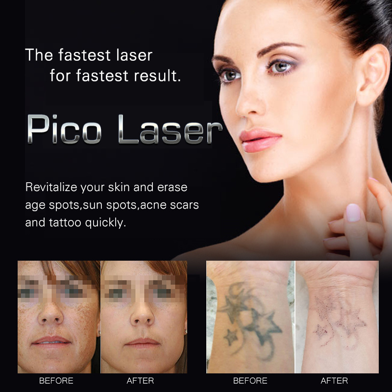 Pikosekunda lasera pigmenta foriga maŝino EL900