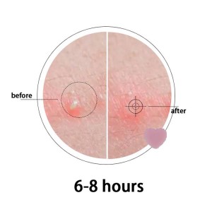 1 buc/18 puncte Plasture hidrocoloid pentru acnee, galben, roz, violet.
