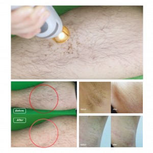 755nm+1064nm Alexandrite nd yag laser hair removal device