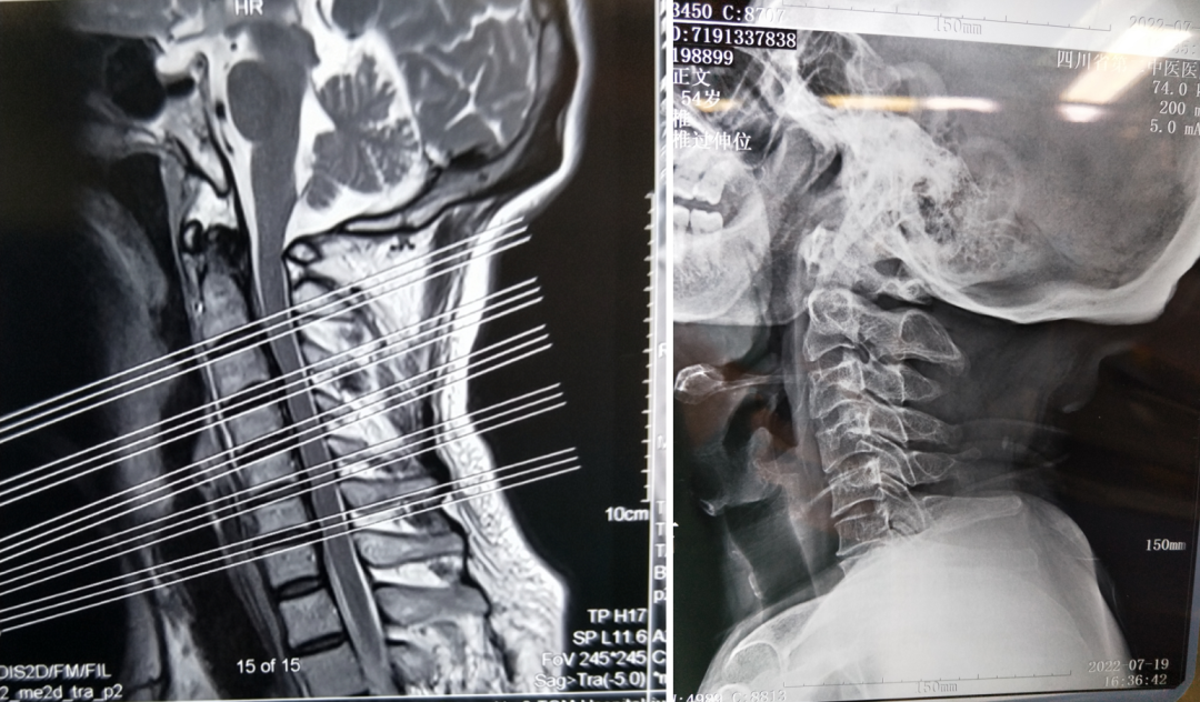 Deljenje ohišja sprednje vratne hrbtenice – sprednje vratne plošče