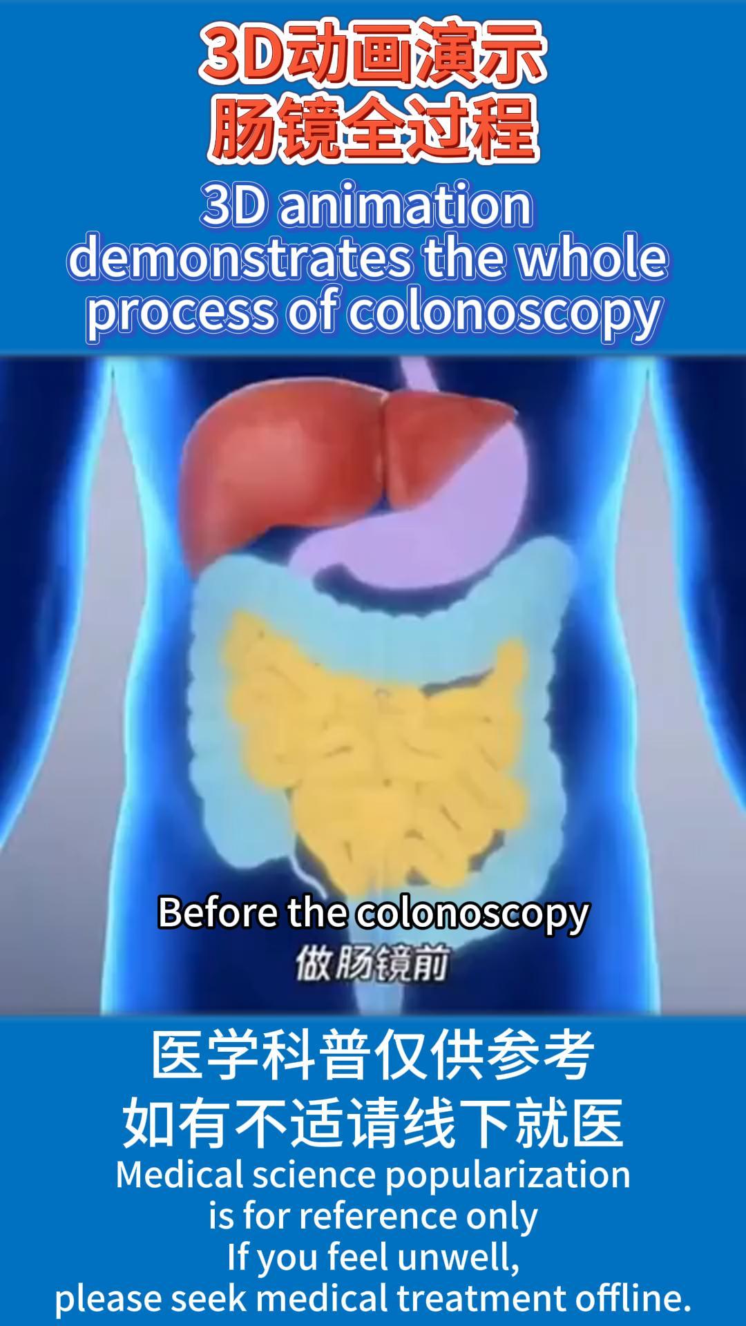 Izinkan saya menunjukkan keseluruhan proses kolonoskopi