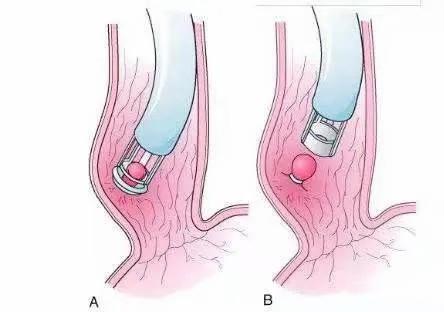 Endoscopic Variceal Ligation(EVL):Another powerful tool for treating esophagogastric varicose veins