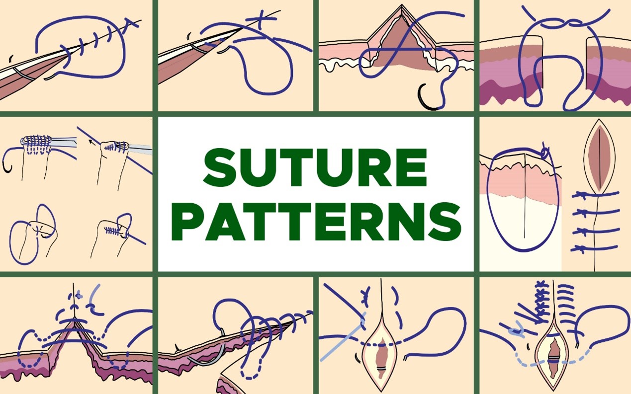 Common Suture Patterns (3) Featured Image