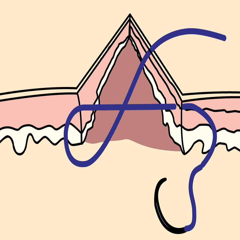 Common Suture Patterns（1）