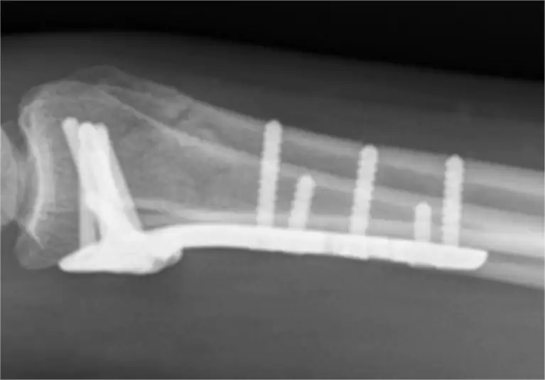 Managing Complex Distal Radial Fractures