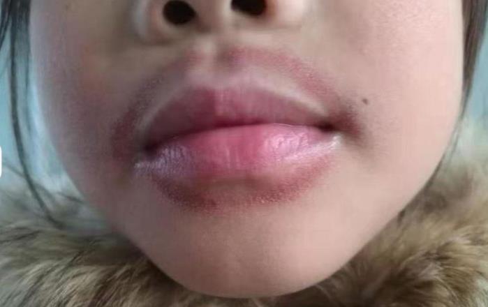 Lip Licker’s Dermatitis: Causes, symptoms and treatment
