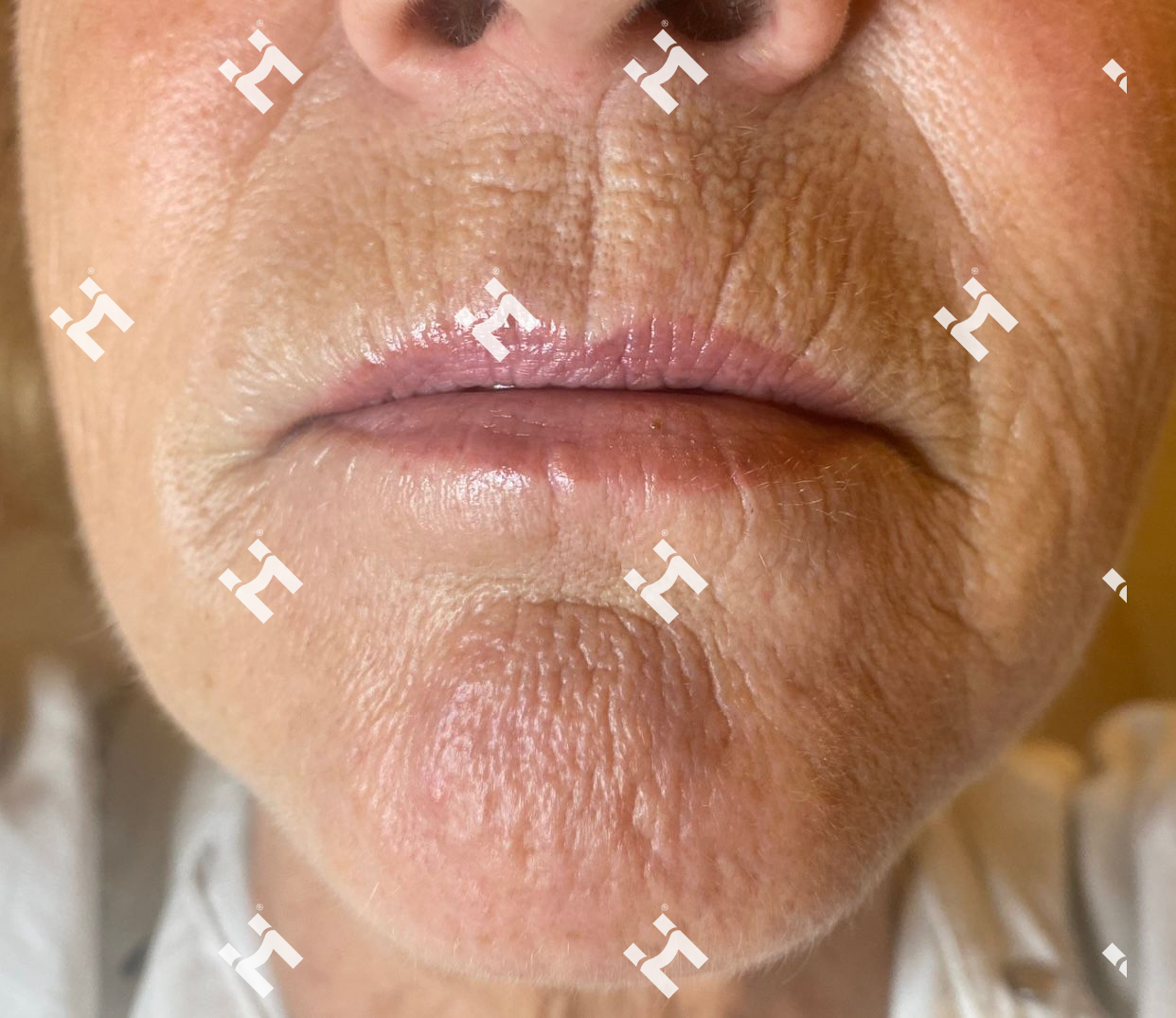 Positive Customer Feedback for 1470 Laser Treatment Targeting Facial Wrinkles