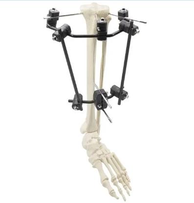 علاج مبتكر: يقدم المثبت الخارجي من السلسلة 8.0 اختراقات في علاج الساق