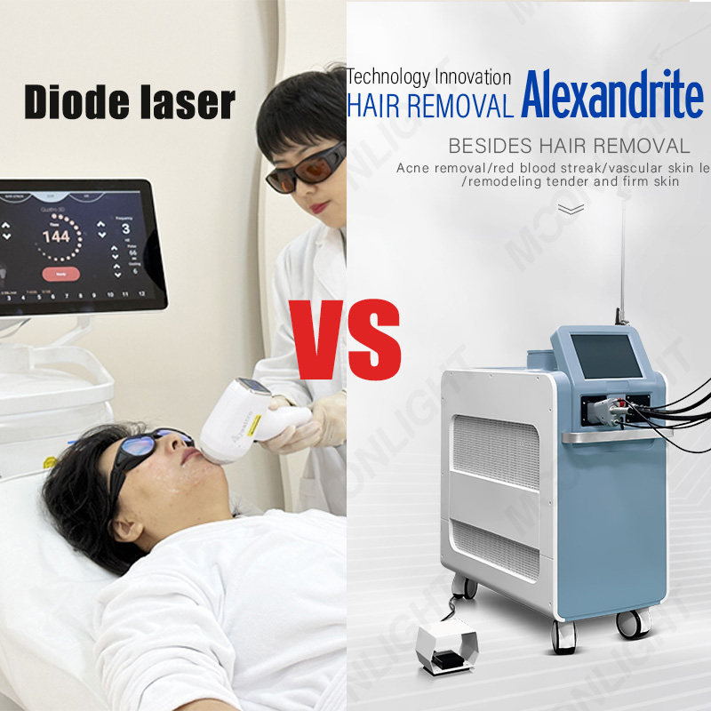 La differenza tra la depilazione con laser ad alessandrite e la depilazione con laser a diodi