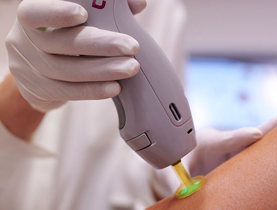 Why Alexandrite laser is best option for hair removal?