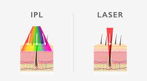 The differences between IPL and laser hair removal