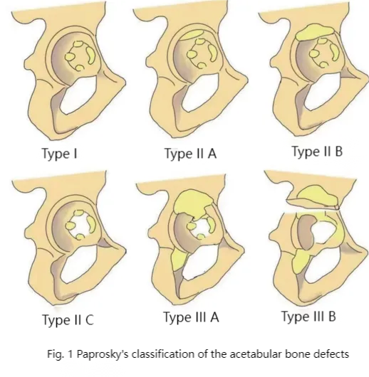 Revision surgery after primary total hip arthroplasty in Crowe type Ⅳ developmental dysplasia of the hip